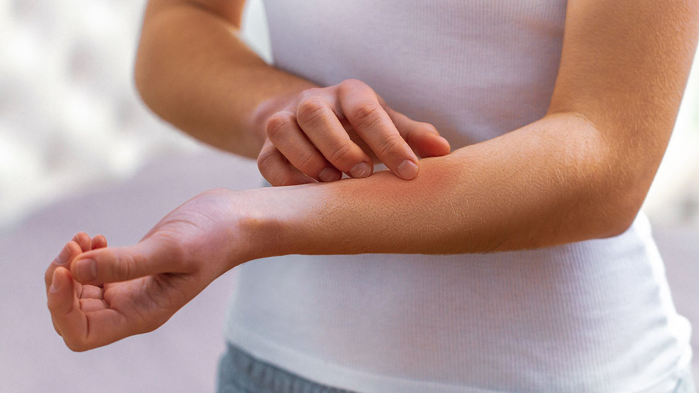 Alergije i osip su čest simptom pada imuniteta.